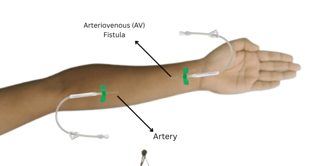 arm health fistula dialysis