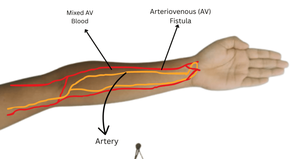 arm healthy fistula